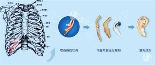 张如鸿医师再造耳术后一年：耳廓形态与听力功能实测！