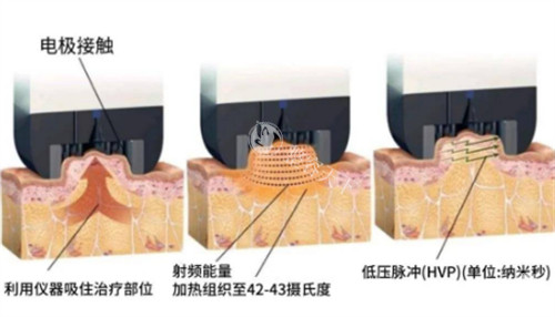 超塑双下巴和下颌缘成效能维持多久？真实情况告诉你！
