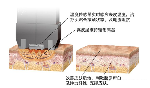 超塑双下巴和下颌缘成效能维持多久？真实情况告诉你！