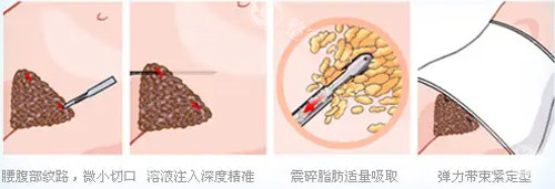 大理整形医院价格表2025年公布：全切双眼皮6000元起/乳晕缩小8000元起/大腿吸脂5000元起