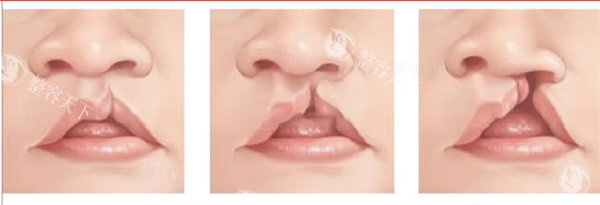 唇腭裂手术费用全攻略：一期1万3.5万/二期2万6万，还有公益项目能减免！