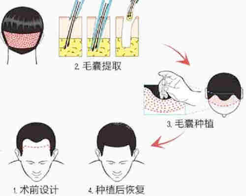 酒泉整形医院价格表2025年详情：开眼角6000元起/大拉皮手术50000元起/玻尿酸丰下巴2000元起