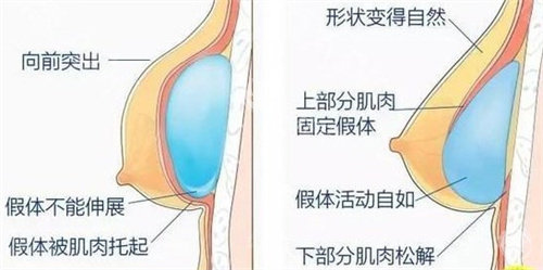 隆胸修复可以同时进行胸部再造吗？特定条件下可以/还需根据个人实际情况决定