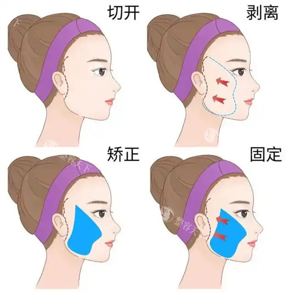贵阳利美康鲁天宇拉皮技术怎么样？擅长运用多种拉皮技术，根据患者的不同情况灵活选择