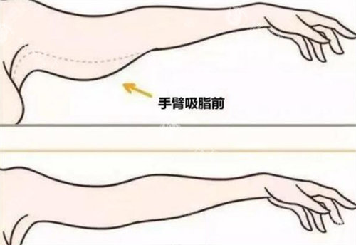 南宁吸脂手术多少钱？吸脂手术收费9800元起，杨其峰医生操作细腻/术后线条平整流畅！