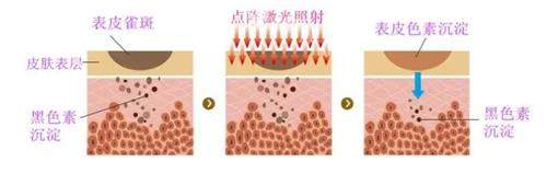 点阵激光对面部哪方面皱纹有效？针对额头纹、眼周细纹、口周纹、法令纹有效