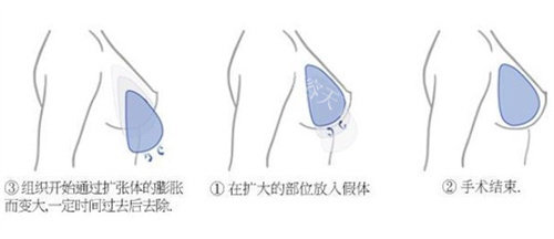 隆胸假体取出后改善要多久？做好这3点改善快一倍！