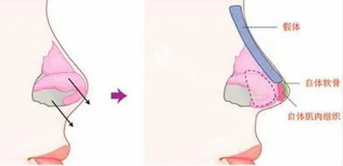 肋骨鼻选黄烨华医生靠谱吗？真实实例+技术优势分析！