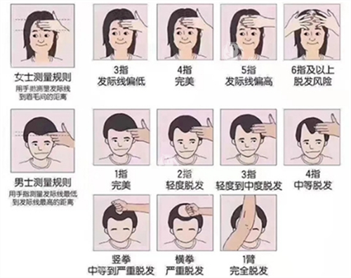 广州贞韩植发费用全公开！发际线种植1万起值不值？