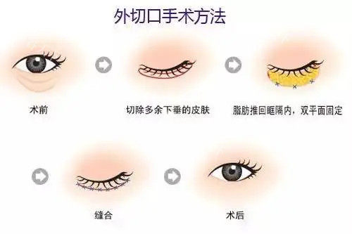 张冰洁和杜园园谁做眼袋修复更好？从修复技术特色/审美风格/整圈评价三维对比给你看