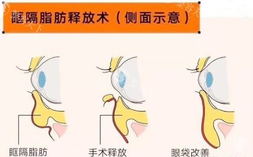 深圳鸿瑞祛眼袋怎么样？技术、医生、价格全解析，看完再决定