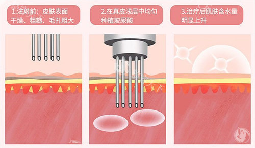 童颜龄三型胶原水光价钱是多少？这篇文章详细介绍童颜龄三型胶原水光价格