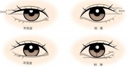 范文亮做双眼皮怎么样？做初眼和高难度眼修复技术都挺在线的