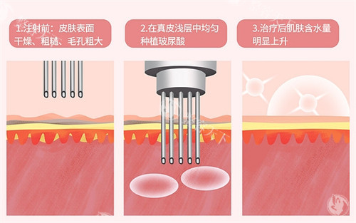 想做童颜龄三型胶原水光注射？先了解价格和适合人群再决定！