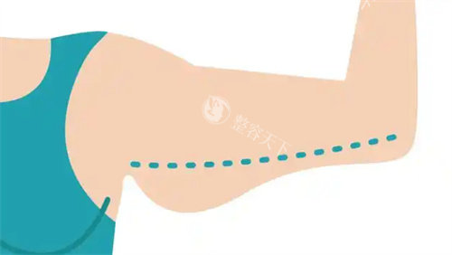 延吉吸脂手术哪家能做？为健康还是建议去大型正规机构手把手筛选可靠的吸脂医院！