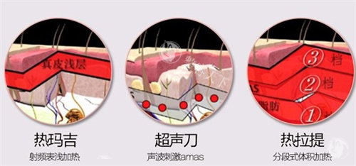 美拉美超声提拉做全脸多少钱？基础版提升、加强版以及多层次打法价格一览