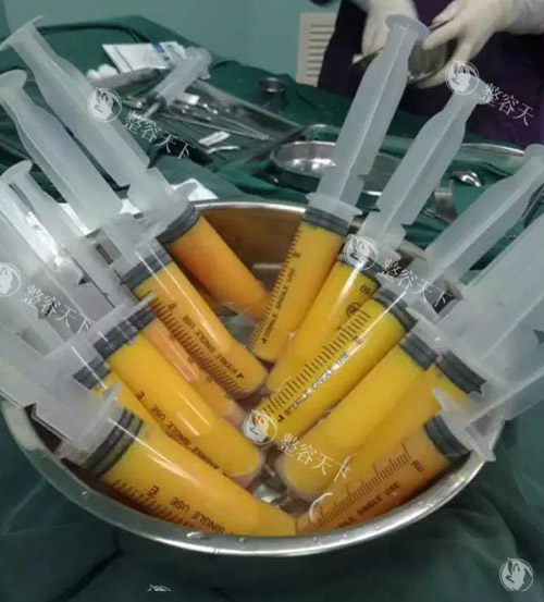 谷廷敏吸脂修复怎么样？30多年吸脂临床经验吸脂/吸脂修复/脂肪填充技术好，闭眼冲