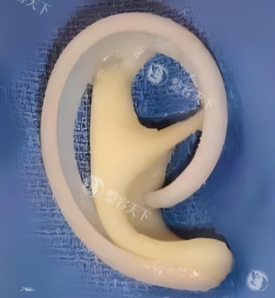 成都八大处耳再造费用多少钱？手术方式很关键！肋软骨法5-9万起、Medpor材料7-12万起