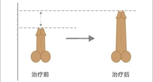 怎样延长阴茎长度?偏方不可靠!阴茎延长手术是可靠方式!分享原理/手术/延长长度