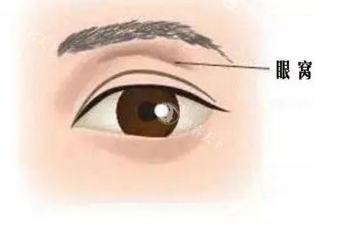 请问我上脸部凹陷怎么填充？面部6大部位凹陷适合的填充材料分享