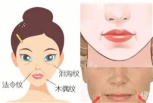 谭永嘉微拉美5.0咋样?谭永嘉微拉美面部提升技术口碑都不错,做微拉美提升出名!