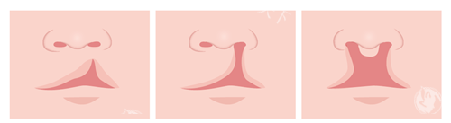 成人兔唇整形需要多少钱?关注2025年修复费用约3~10万元不等,剖析手术复杂程度对价格影响!