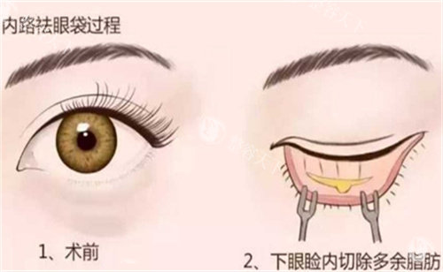 长沙黛妃医美祛眼袋好吗？技术娴熟、改善快，结果自然值得一试！