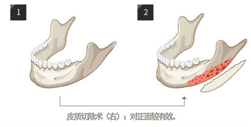 上海杨君毅磨骨怎么样?做下颌角截骨/颧骨内推等技术娴熟、口碑优异