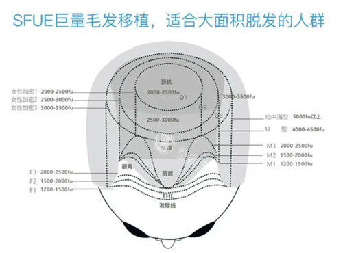 微针植发如何实现