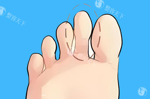 术后结果能维持多久？二脚趾缩短手术的5年跟踪数据报告！