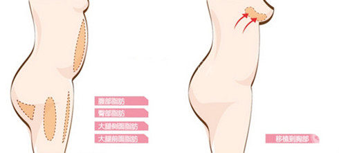 假体隆胸VS自体脂肪：抗衰界