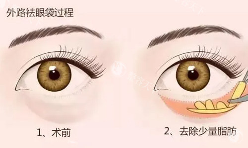 厦门思明美仑美奂整形祛眼袋结果佳，创伤小、医生经验足、价格透明