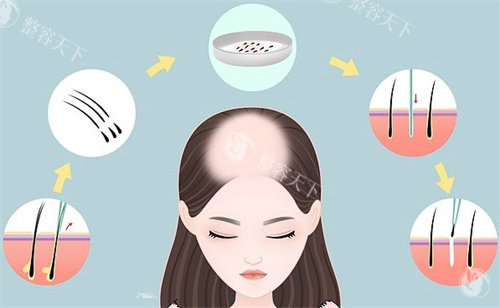 微针植发如何实现