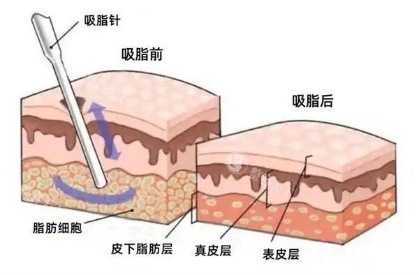 30岁后还能拥有少女脸？面部吸脂适合人群大公开，看看你符合条件吗