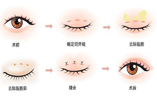 成都齐丙迪医生全切双眼皮实例集：不同眼型的定制化方案！