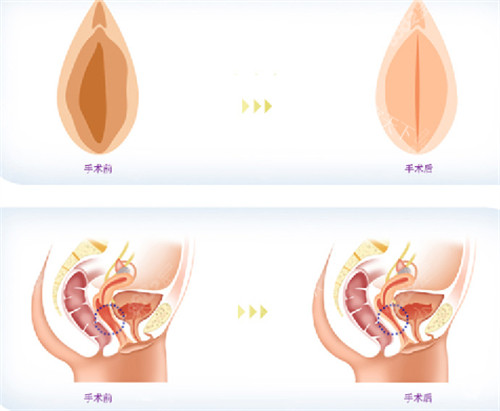 厦门荟美天成整形医院收费标准25版：眼鼻胸吸脂价目表全曝光，低价项目低至580元起