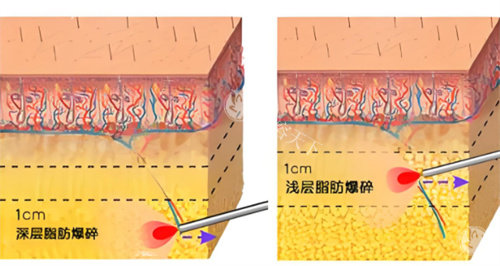 冷冻溶脂和激光溶脂哪个好？各有优势，激光溶脂体验感好经济实惠