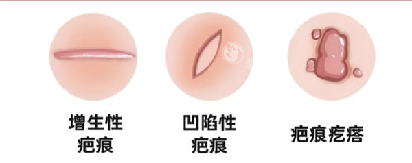 苏映军治疤痕怎么样？耶鲁博士后超减张缝合技术，儿童成人疤痕疙瘩修复平整如初！