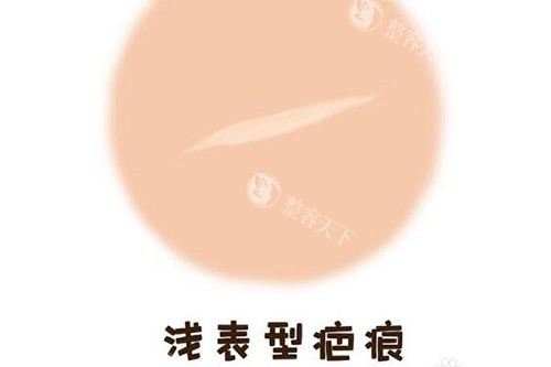 苏映军治疤痕怎么样？耶鲁博士后超减张缝合技术，儿童成人疤痕疙瘩修复平整如初！