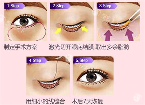 哈尔滨哪家医院做眼袋结果好？这五家机构眼部减龄结果超赞，口碑爆棚推荐！