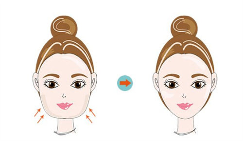 西安籍建华整形医生怎么样？3D导板+内窥镜精密截骨，西北轮廓整形优选，难约但真香！