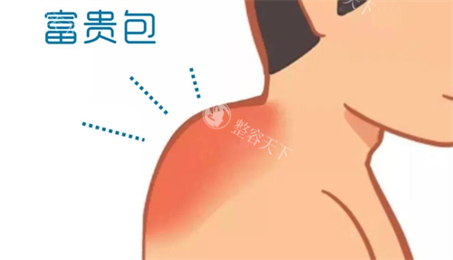 惊呆了！黄学锋消除富贵包价格大揭秘，看完不纠结！还有医院详情大公开！