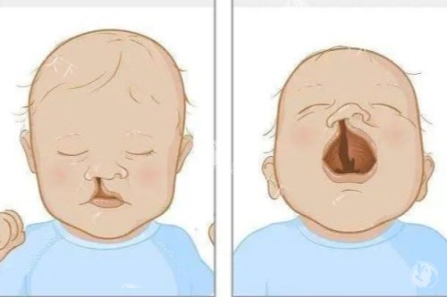 先天性唇腭裂国内有免费治疗政策吗？一文说清申请条件、流程和定点医院名单！