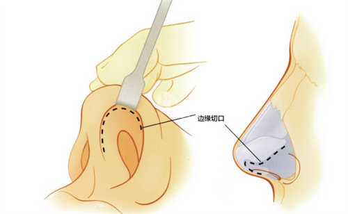 桂林华美黄辉文鼻修复技术好吗？自然真实成效能维持多久？揭秘技术派医生如何解决鼻整形失败难题