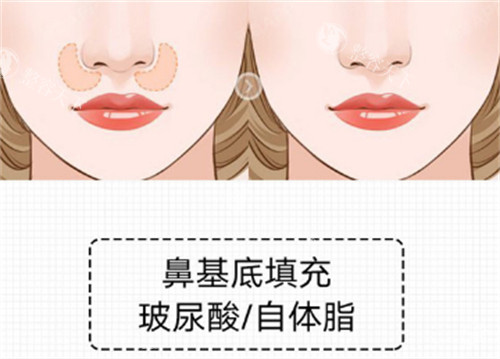 鼻基底填充适合哪些人群？从年龄到骨骼结构多方面分析你的适配度