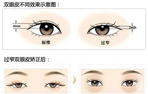 魏志香双眼皮修复费用明细曝光：3D仿生重睑术如何做到性价比与结果双赢？