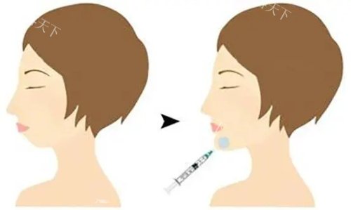 下巴打玻尿酸多少钱一支?下巴打玻尿酸需要打几针？
