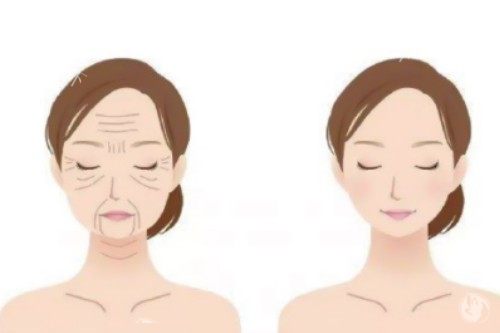 男性抗衰专属方案！“射频微针+下颌缘提升”如何解决“发腮+双下巴”？
