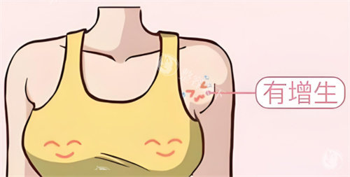 副乳切除适合哪些人？5类人群需特别注意，看看你是否符合条件