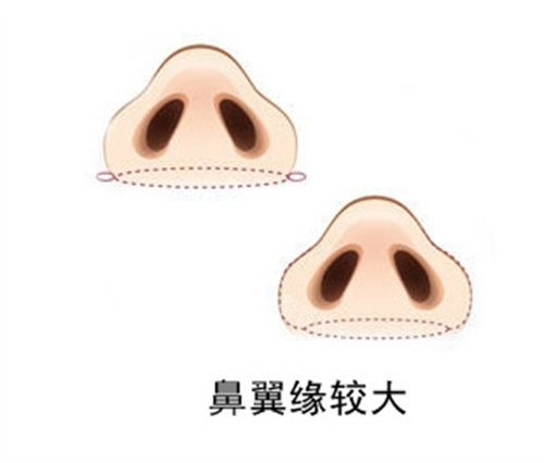 于建刚做鼻子口碑好吗​？在做鼻子方面积累了不错的口碑